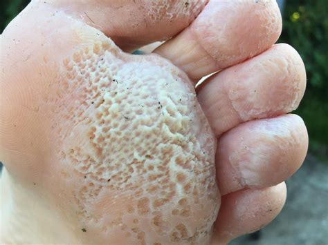 trypophobia feet